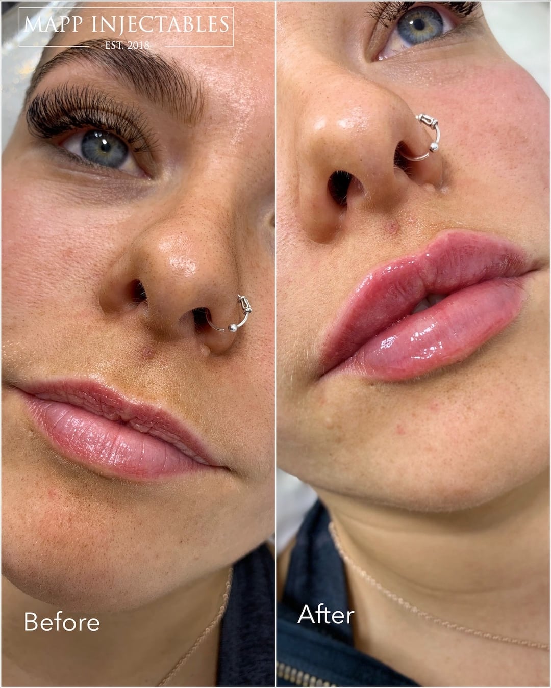 Lip Filler Photos High quality video and photos of our results
